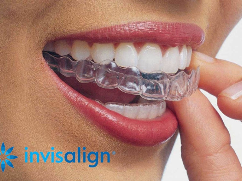 INVISALIGN - Ortodoncia invisible 